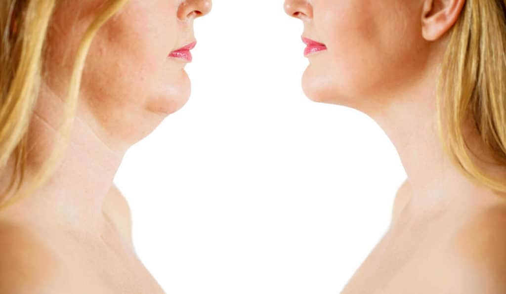 Double Chin treatment Dagenham before and after results
