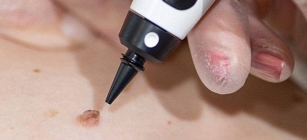 After Skin Tag Removal Dagenham