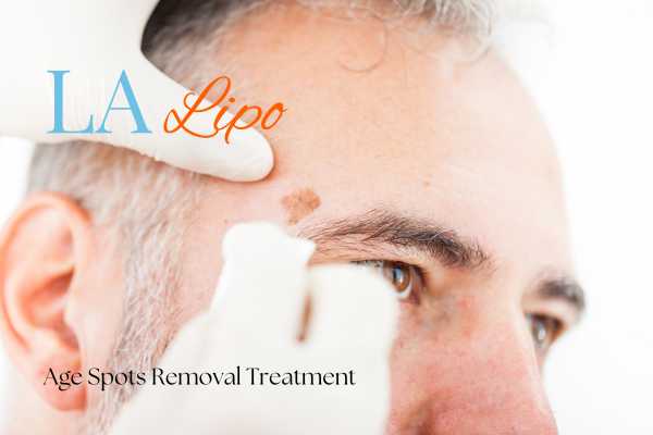 What Are the Most Effective Treatments for Age Spots Dagenham?