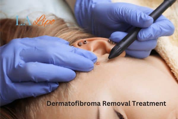 Dermatofibroma Removal Treatment Dagenham