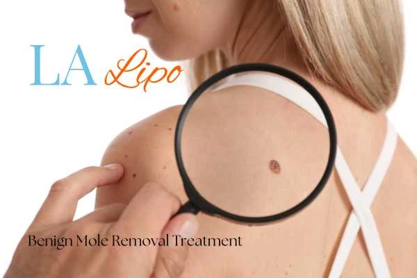 Why getting moles removed Dagenham can boost your confidence!