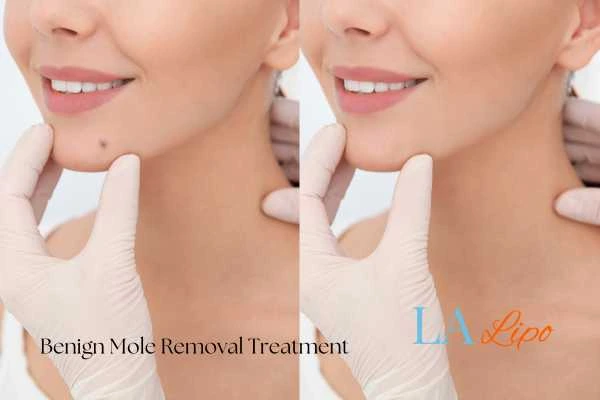woman's before and after mole removal Dagenham results