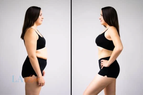 LA-EMS Body Sculpting Dagenham results before and after of womans results on body toning.