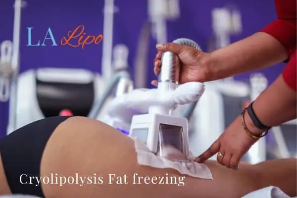 women getting fat freezing Dagenham