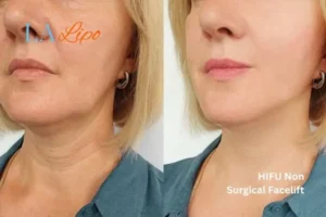 hi-fu for wrinkles Dagenham before and after results