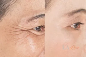 Before and after results of woman - HI-fu wrinkles reduction treatment Dagenham