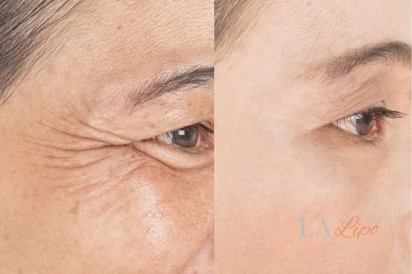 Before and after results of woman - HI-fu wrinkles reduction treatment Dagenham