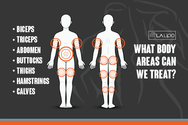 Graphic to show areas you can have LA-EMS Body Sculpting Dagenham treatment.