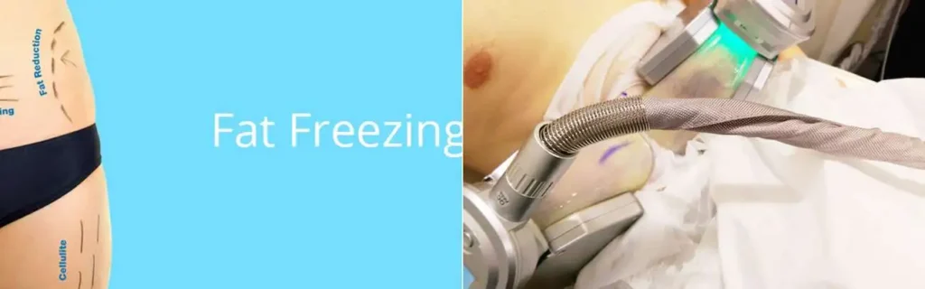 Fat freezing Dagenham on multiple areas of the body