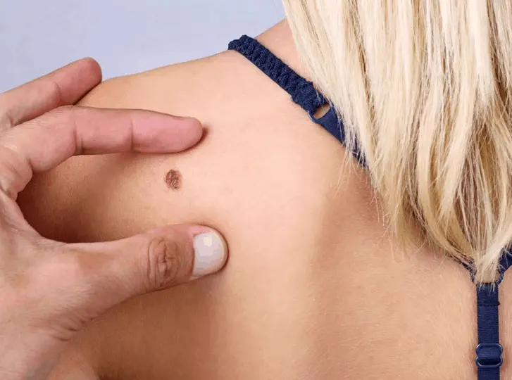 woman having mole removal Dagenham consultation before treatment.