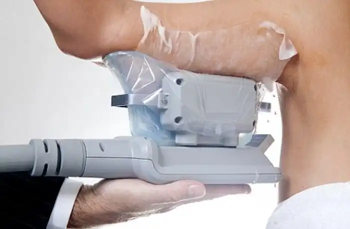 Picture of fat freezing Dagenham on the upper arms.