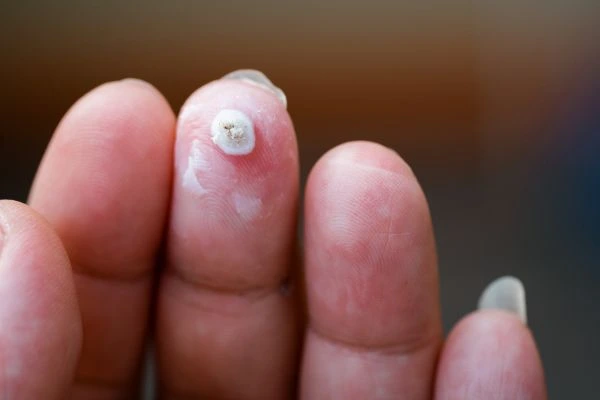 wart on person finger - cryotherapy to treat from LA LIPO Dagenham