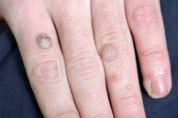 photo of warts on person hand - see wart removal Dagenham from LA LIPO