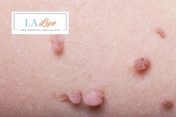 Does cryopen skin tag removal Dagenham hurt? Find out now call our team today!