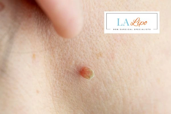 Book skin tag removal Dagenham today speak to our team now!