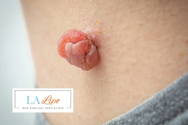 Interested in skin tag removal Dagenham? Concerned about the pain? Find out more today!