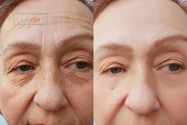 The powerful benefits of Morpheus8 Treatment Dagenham - Call Our team today!
