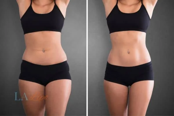 before and after results of non-surgical treatment to help a woman's body image and mental health Dagenham