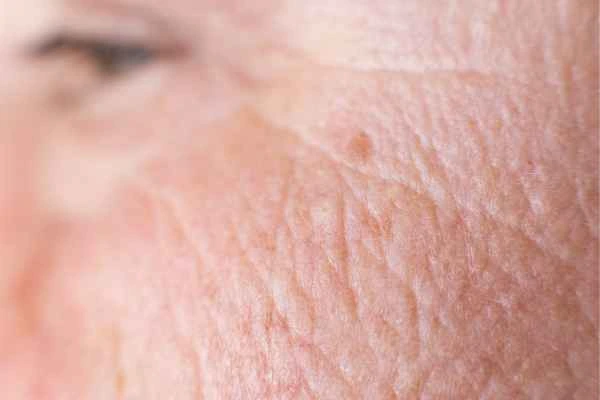 close up picture of a woman's face showing an age spot Dagenham