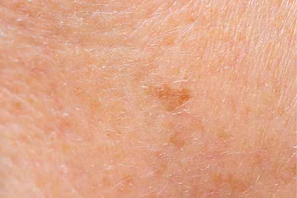 close up picture of age spots Dagenham