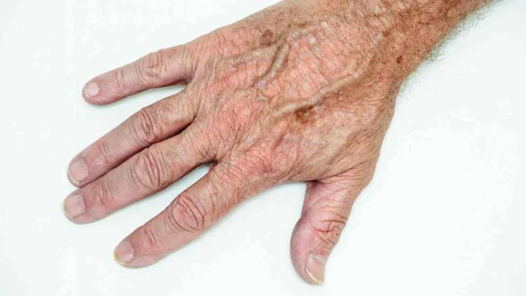 Male hand showing age spot Dagenham
