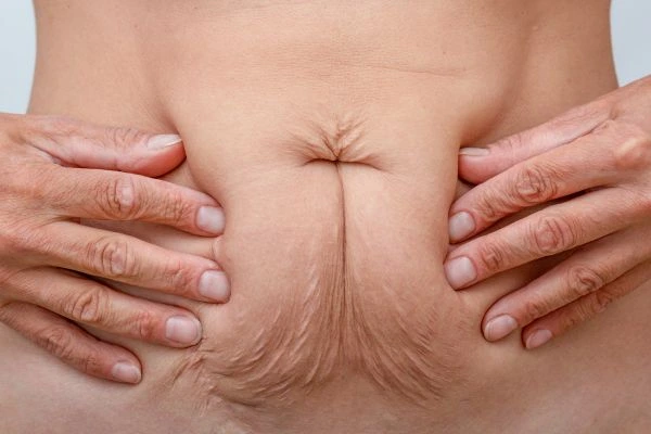 Image of a woman's stomach with loose skin - example of skin tightening Dagenham options